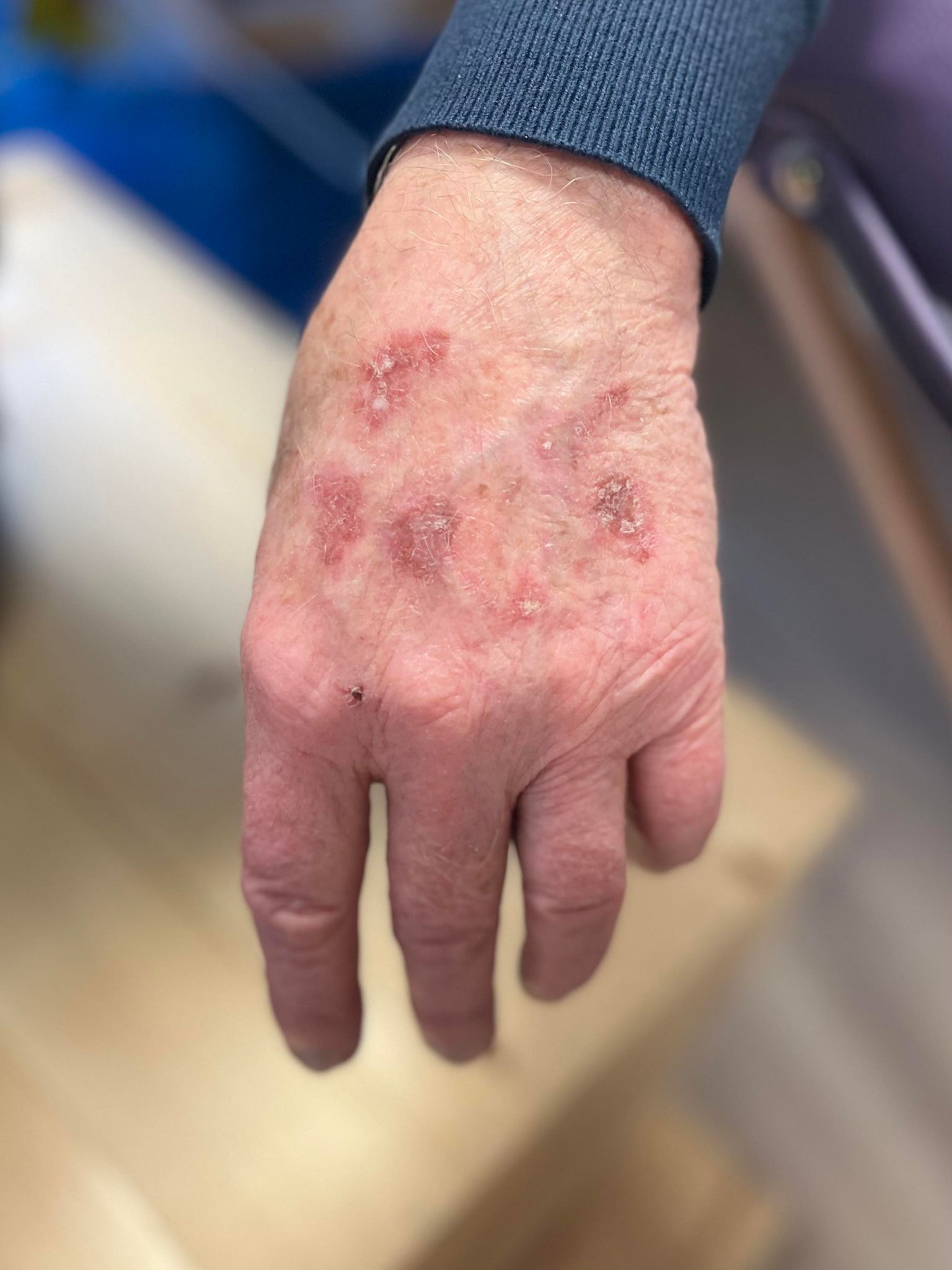 Réaction allergique cutanée sur la peau — eczéma traité par la méthode Bye Bye Allergies à Vaugneray